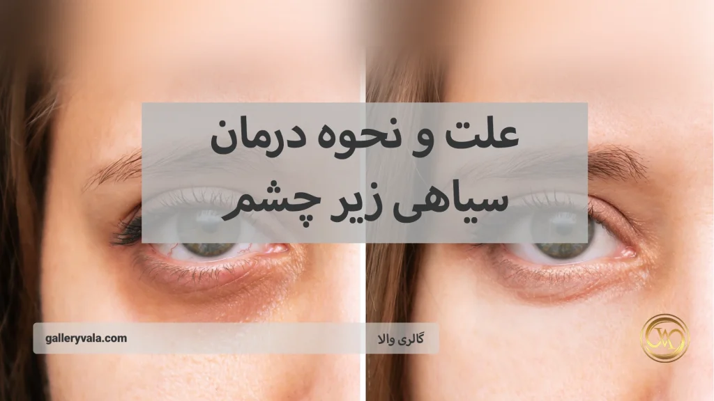 سیاهی زیر چشم - بررسی علت و نحوه درمان سیاهی زیر چشم